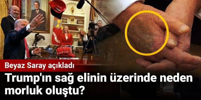 Trump'ın sağ elinin üzerinde neden morluk oluştu? Beyaz Saray açıkladı